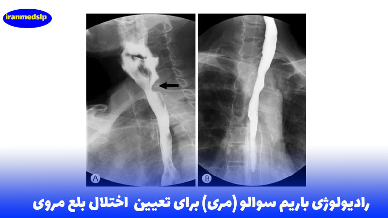 تصویر برداری بلع با باریم سوالو