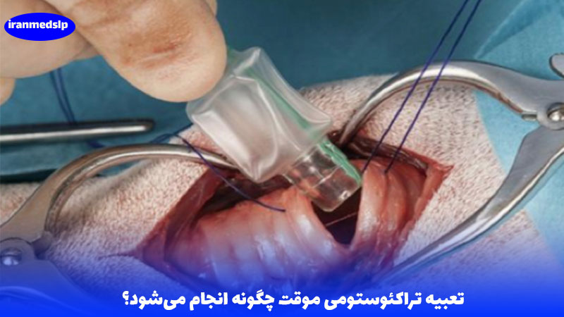 تعبیه تراکئوستومی موقت