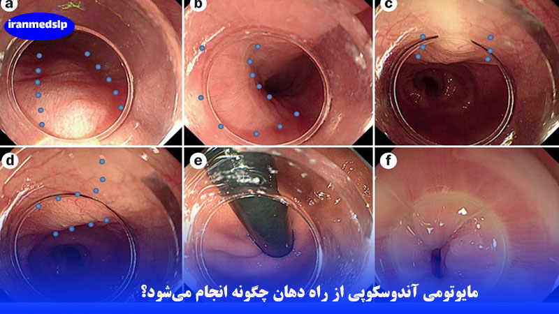 مایوتومی آندوسکوپی از راه دهان