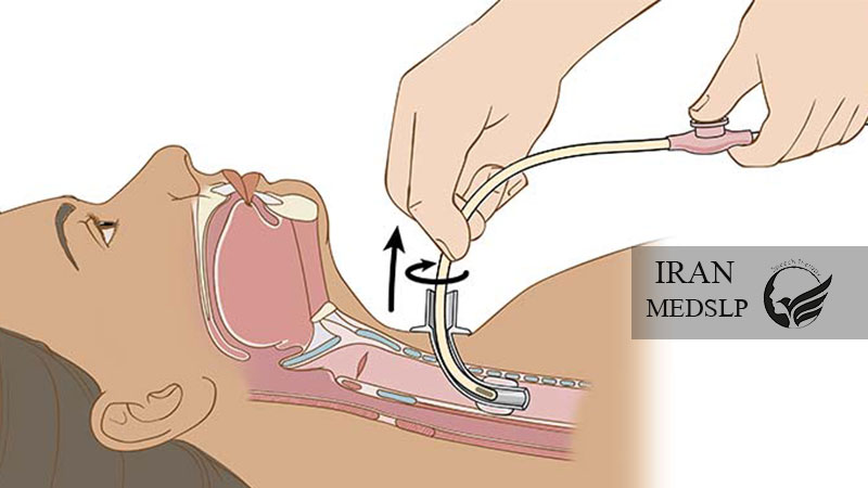 آسپیراسیون و ساکشن تراکئوستومی
