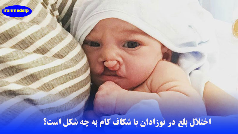 اختلال بلع در شکاف لب و کام