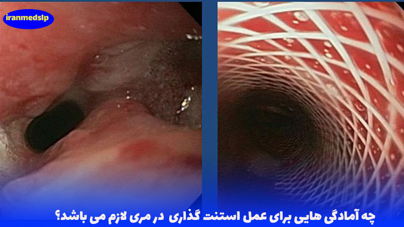 آمادگی عمل استنت مری