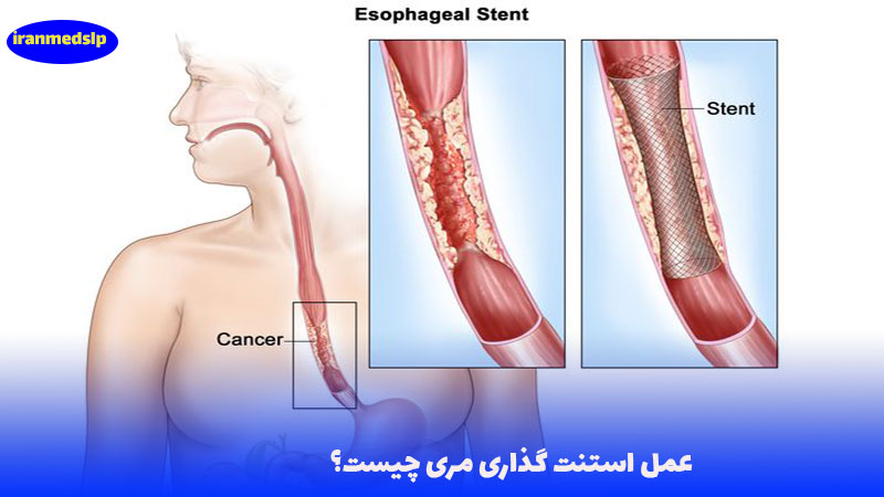 عمل استنت گذاری مری