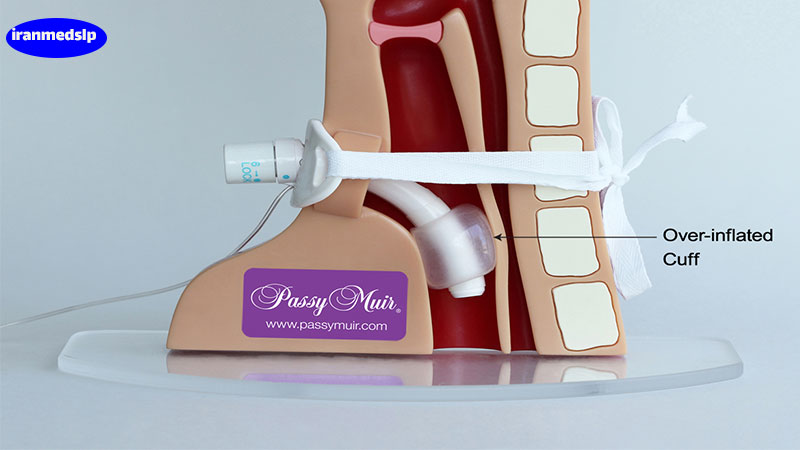 what-is-temporary-tracheostomy